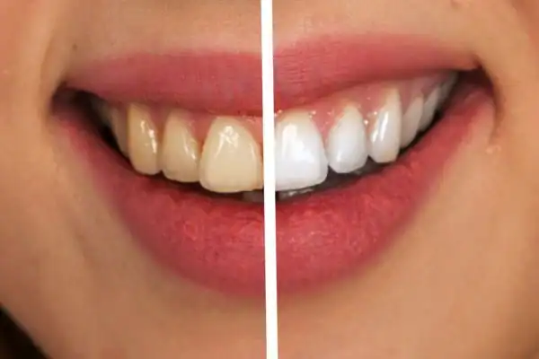 Before and after results of Blue Light Teeth Whitening Winchester